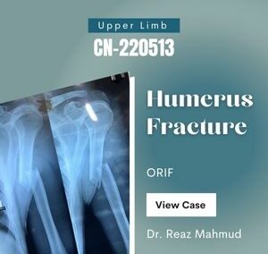 Fracture Shaft of Humerus | ORIF [CN-220513]
