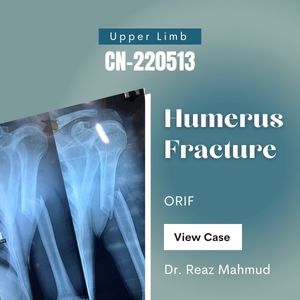 Fracture Shaft of Humerus | ORIF [CN-220513]