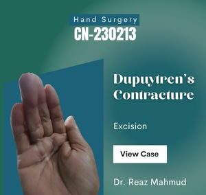 Dupuytren’s Contracture Excision [CN-230213/2]