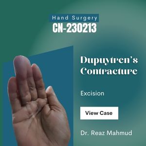 Dupuytren’s Contracture Excision [CN-230213/2]