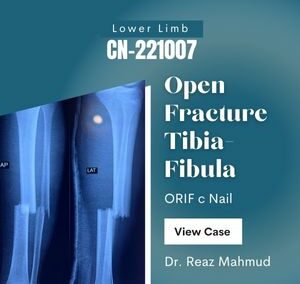Open Fracture Tibia-Fibula | ORIF [CN-221007]