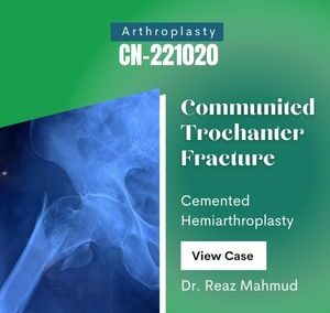 Hip Hemiarthroplasty on Trochanteric Fracture [CN-221020]