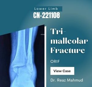 Trimalleolar Fracture | ORIF [CN-221108]