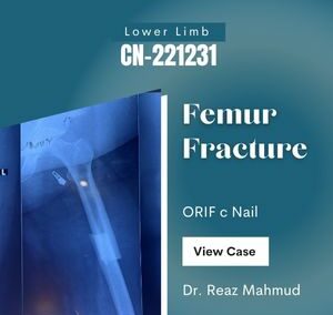 Femoral Shaft Fracture | ORIF [CN-221231]