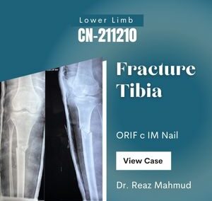 Open Fracture Tibia-Fibula | ORIF c ILIM Nail [CN-211210]