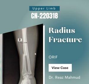 Fracture Shaft of Radius | ORIF c Plate Screw [CN-220318]