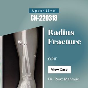 Fracture Shaft of Radius | ORIF c Plate Screw [CN-220318]