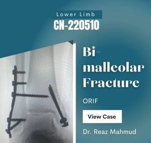Bimalleolar Ankle Fracture | ORIF [CN-220510]