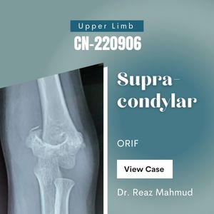 Supracondylar Fracture | ORIF c K-wires [CN-220906]