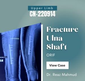 Fracture Shaft of Ulna | ORIF c Plate Screw [CN-220914]