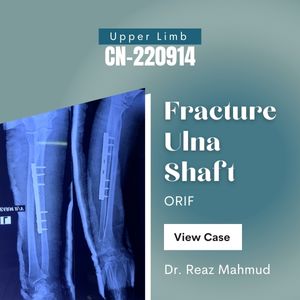 Fracture Shaft of Ulna | ORIF c Plate Screw [CN-220914]