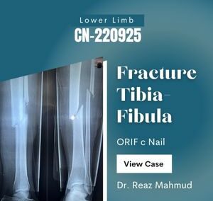 Fracture Tibia-Fibula | ORIF c ILIM Nail [CN-220925]
