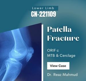 Patella Fracture | ORIF [CN-221109]
