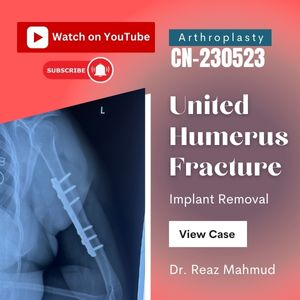 United Humerus Fracture | Implant Removal [CN-230523]