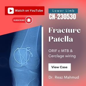 Fractured Patella | ORIF [CN-230530]