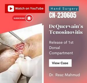 Release of 1st Extensor Compartment in DeQuervain’s Disease [CN-230911]
