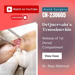 Release of 1st Extensor Compartment in DeQuervain’s Disease [CN-230911]