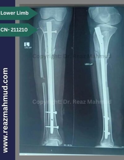 211210- Fracture Tibia Postoperative