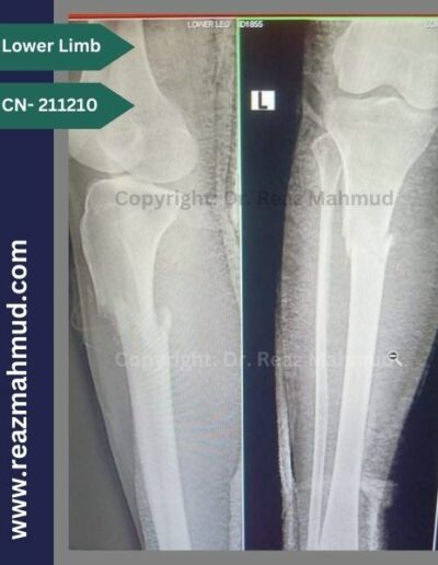 211210- Fracture Tibia Preoperative