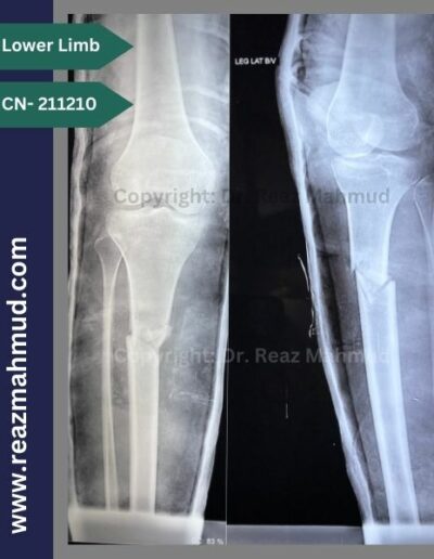 211210- Fracture Tibia Preoperative