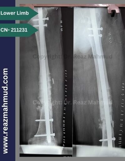 211231 SOF c Implant failure postoperative