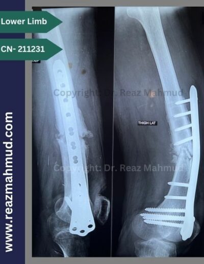 211231 SOF c Implant failure preoperative