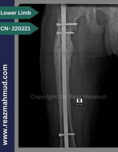 220221- nonunion femur follow up