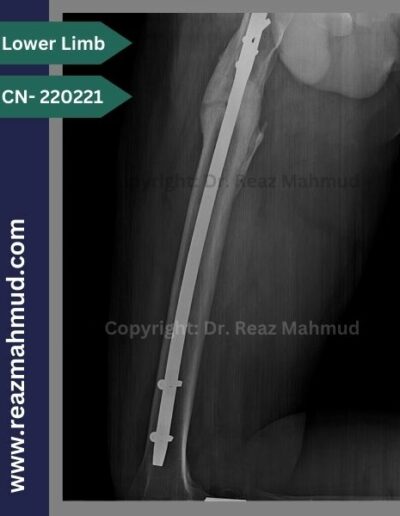 220221- nonunion femur follow up