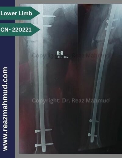 220221- nonunion femur follow up