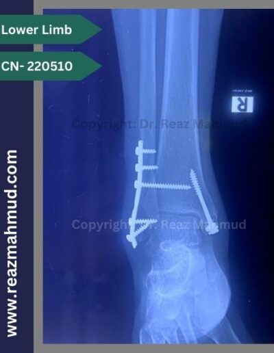 220510- bimalleolar postoperative (6)