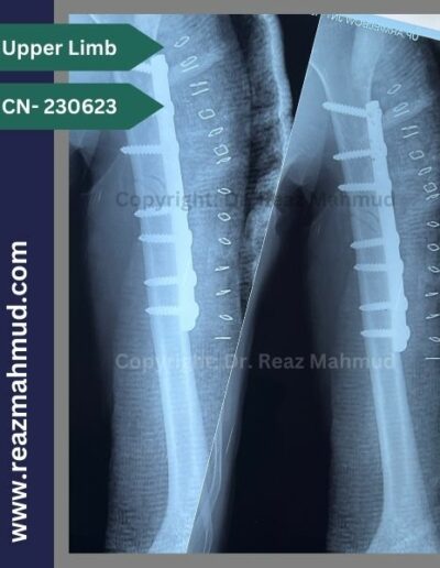 220513- Humerus Fracture Postoperative