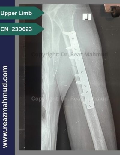 220513- Humerus Fracture Postoperative follow up