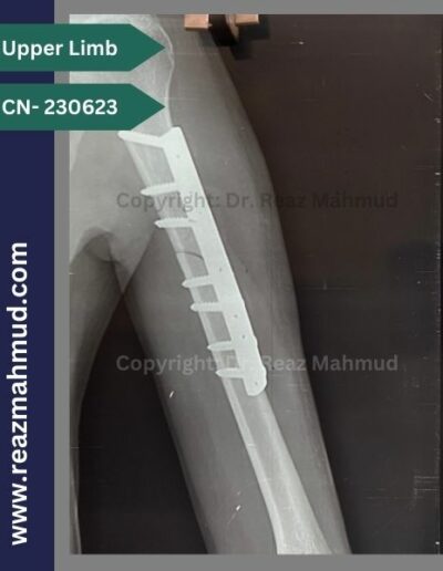 220513- Humerus Fracture Postoperative follow up