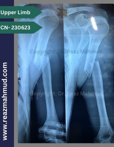 220513- Humerus Fracture Preoperative