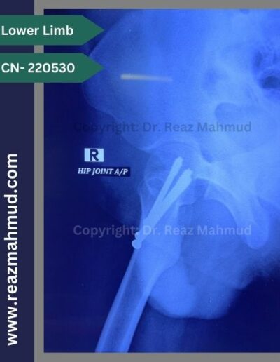 220530- cannulated hip screw follow up