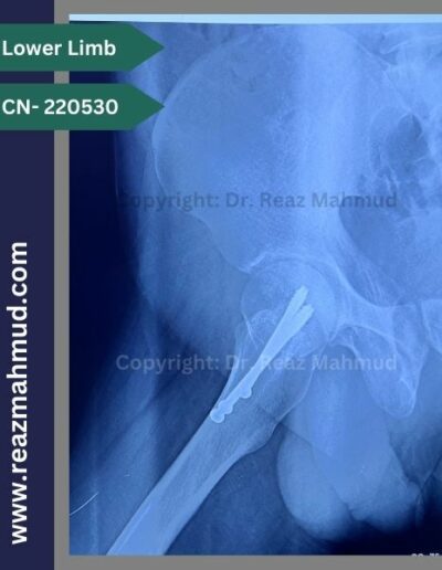 220530- cannulated hip screw follow up