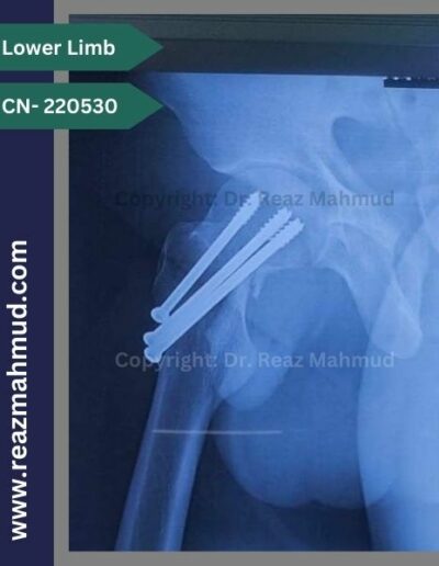 220530- cannulated hip screw follow up