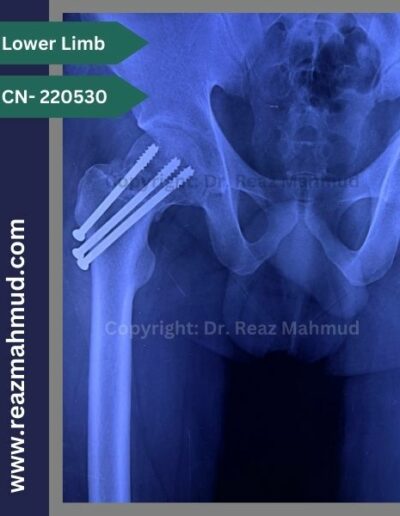 220530- cannulated hip screw follow up