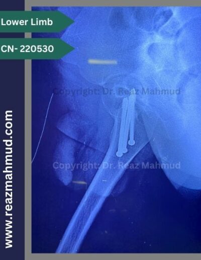 220530- cannulated hip screw follow up