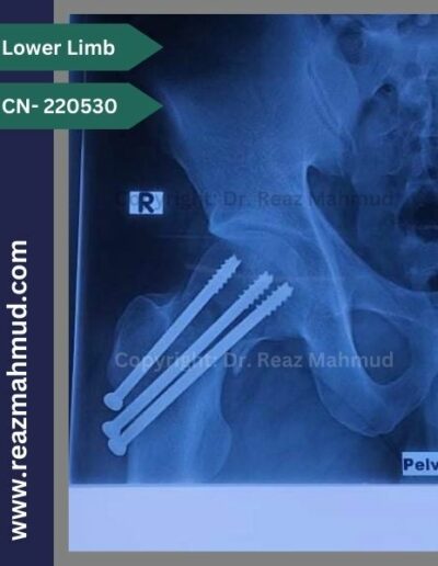 220530- cannulated hip screw follow up