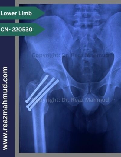 220530- cannulated hip screw follow up