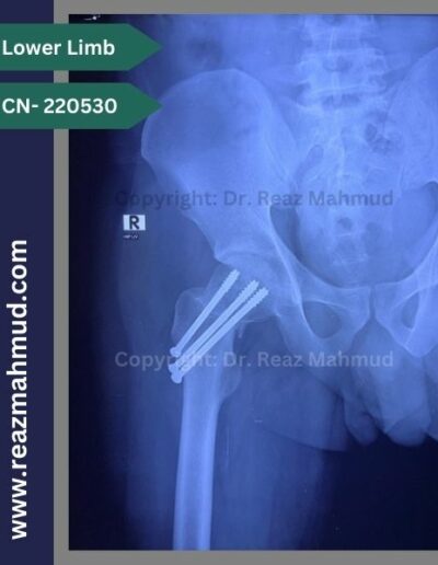 220530- cannulated hip screw follow up