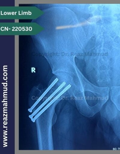 220530- cannulated hip screw follow up