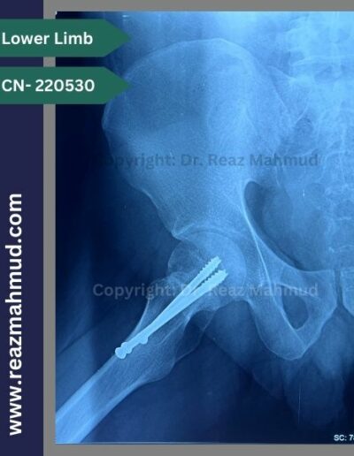 220530- cannulated hip screw follow up