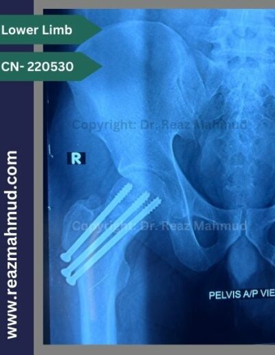 220530- cannulated hip screw follow up