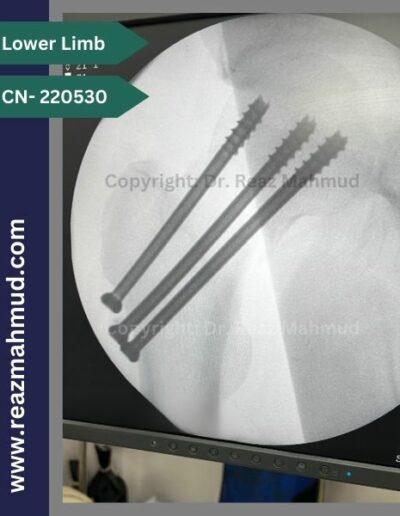 220530- cannulated hip screw peroperative