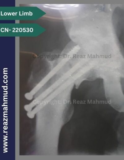 220530- cannulated hip screw postoperative