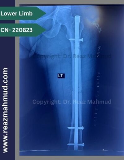 220823- Femur Fracture postoperative