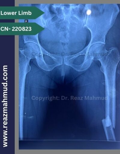 220823- Femur Fracture preoperative