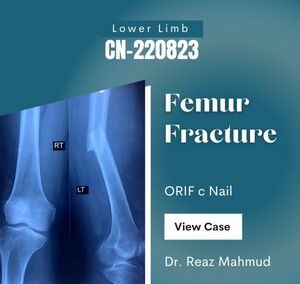 Femur fracture | ORIF c Nail [CN-220823]